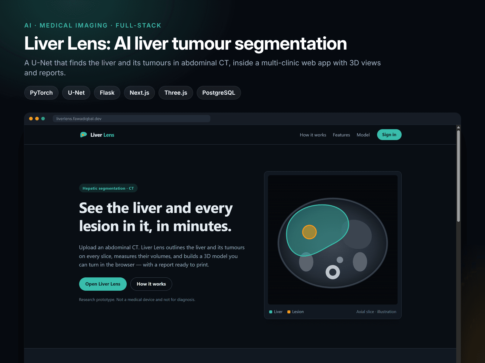 Liver Lens: AI Liver Tumor Segmentation from CT Scans – image 1